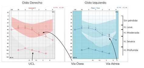 Gráfico de umbrales auditivos en audiometría