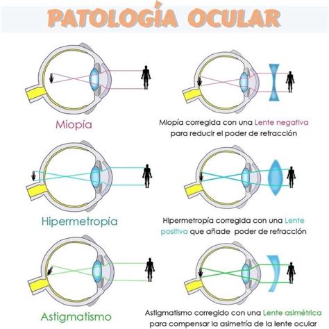Esquema: Patologías oculares comunes que causan baja visión