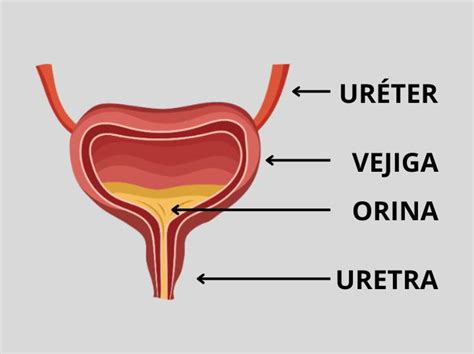 Esquema de la vejiga urinaria normal y una vejiga con globo vesical (distendida)
