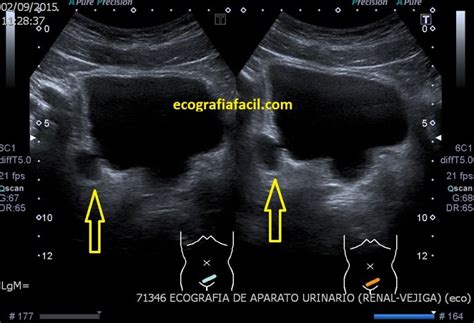 Imagen de una ecografía vesical mostrando distensión