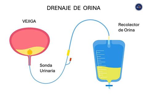 Ilustración detallada de la inserción de una sonda vesical
