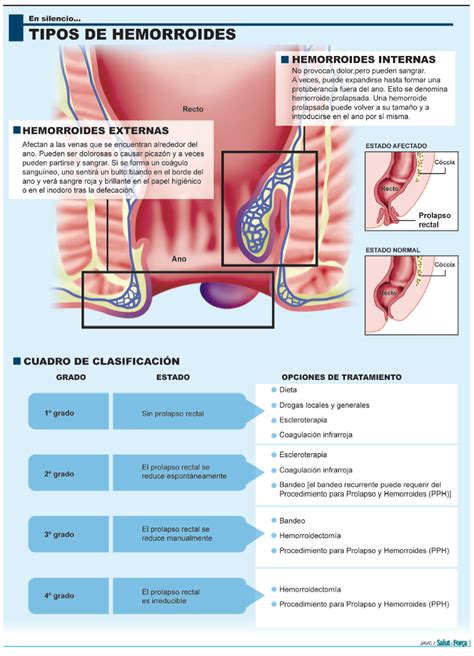 Infografía: Anatomía de las hemorroides internas y externas