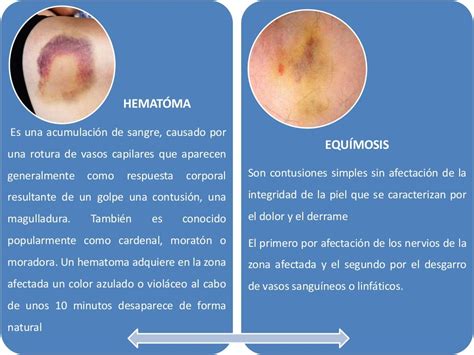 Diferencia entre equimosis y hematoma con esquema de las capas de la piel