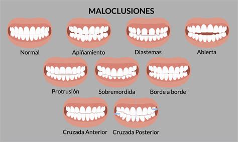 Foto comparativa de diferentes tipos de maloclusión dental