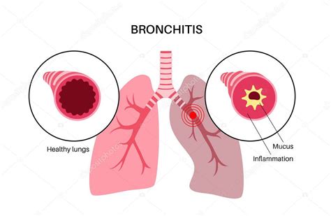 Esquema anatómico mostrando la inflamación de los bronquios comparada con un bronquio sano.