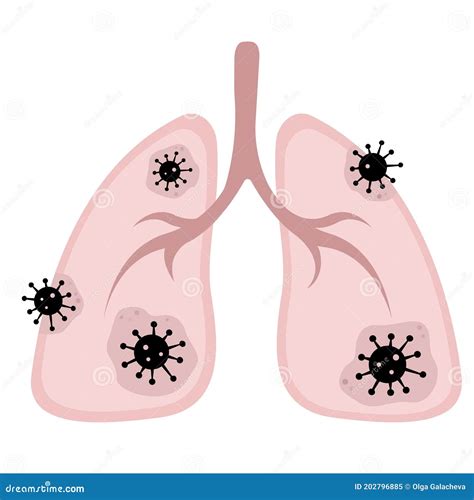 Ilustración de pulmones afectados por neumonía