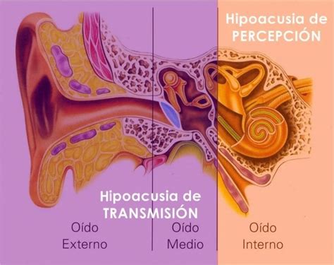 Esquema de las causas de la hipoacusia o pérdida auditiva