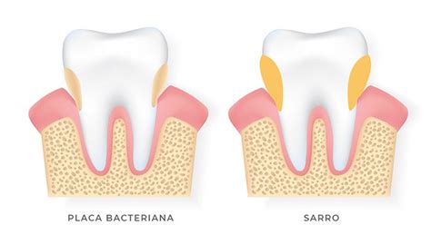 Esquema de la formación de placa y sarro en los dientes