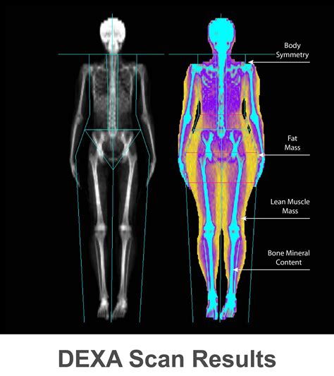 Diagrama de un escáner DEXA midiendo la densidad ósea