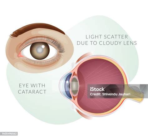 Ilustración de un ojo con catarata
