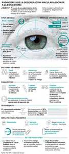 Infografía sobre la Degeneración Macular Asociada a la Edad (DMAE) y sus tipos