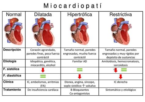 Esquema o diagrama de un corazón con miocardiopatía dilatada