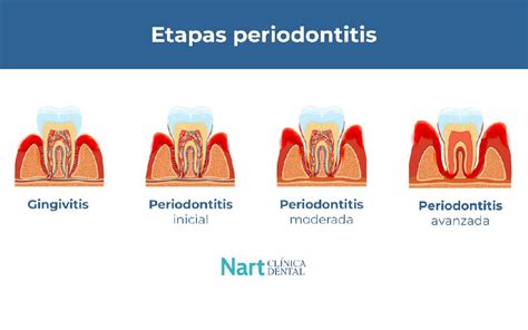 Ilustración de las etapas de la periodontitis y cómo afecta al hueso y la encía