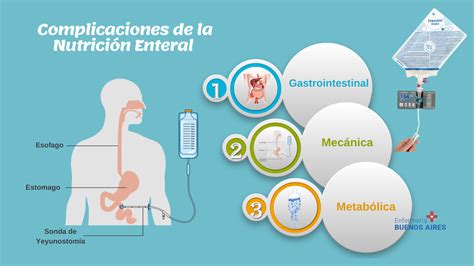 Esquema de un sistema de nutrición enteral domiciliaria