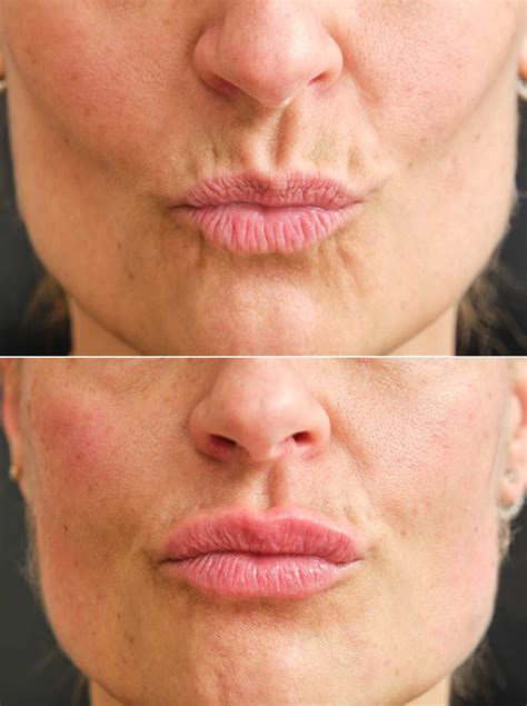 Close-up de la boca y labios finos de una anciana, con arrugas peribucales