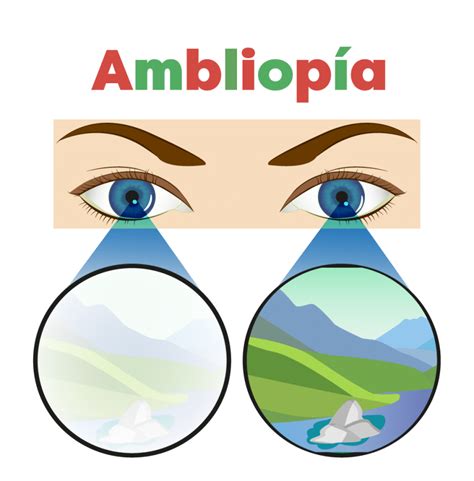 Esquema de un ojo con ambliopía y cómo actúa el parche ocular cubriendo el ojo sano para estimular el ojo vago en niños