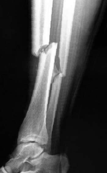 Radiografía de una fractura de tibia y peroné