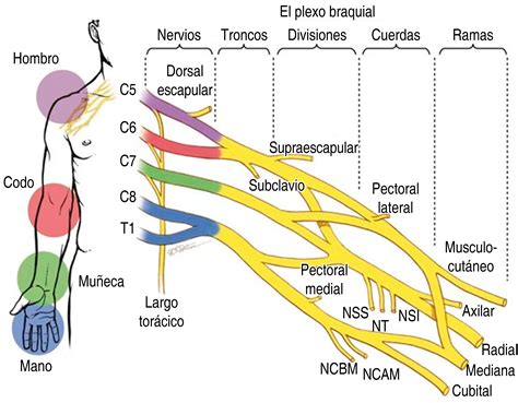 Esquema del plexo braquial y sus posibles puntos de lesión