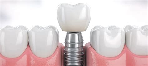 Infografía del funcionamiento de los implantes con control remoto y algoritmo de IA