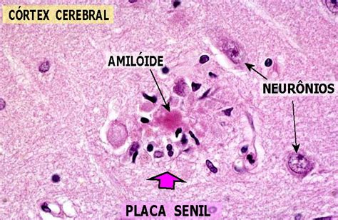 Micrografía de placas amiloides y ovillos neurofibrilares