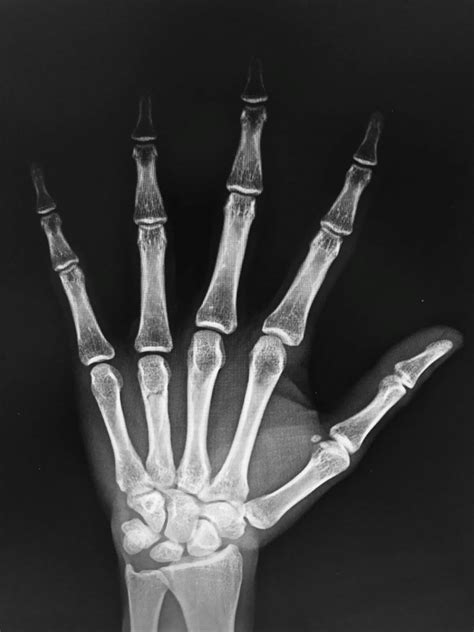 Radiografía de una mano con artrosis en las articulaciones interfalángicas