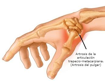 Ilustración de la articulación trapecio-metacarpiana del pulgar
