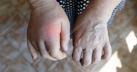 Fotografía de manos hinchadas en un adulto mayor