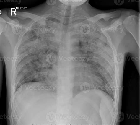 Radiografía de tórax con lesiones tuberculosas