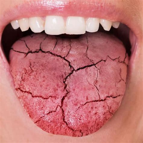 Gráfico de barras mostrando la prevalencia de xerostomía y candidiasis oral en pacientes paliativos.