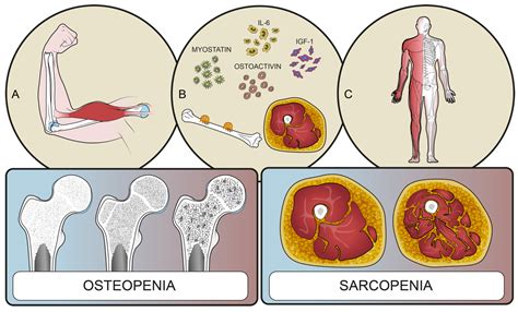 Infografía: Relación entre sarcopenia, osteoporosis y osteosarcopenia en el adulto mayor