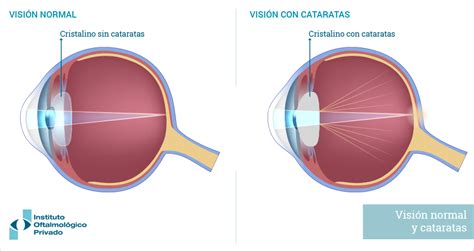 Infografía comparativa de la visión normal y la visión afectada por cataratas