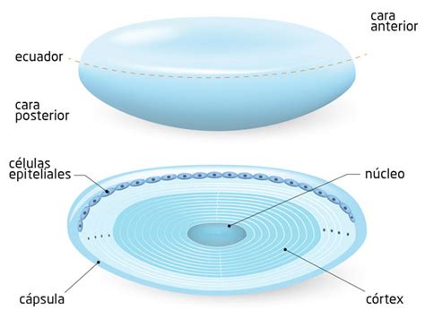 Diagrama de la estructura del ojo, destacando el cristalino y su opacificación por cataratas