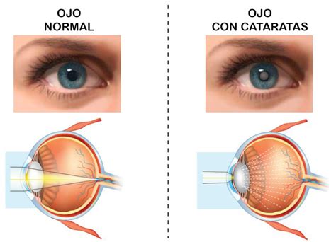 Imagen ilustrativa de cómo se ven los síntomas de las cataratas: halos alrededor de las luces y visión borrosa