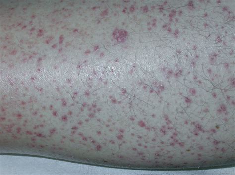 Imagen clínica de púrpura perifolicular con queratosis infundibular y pelos «en sacacorchos» en extremidades inferiores.