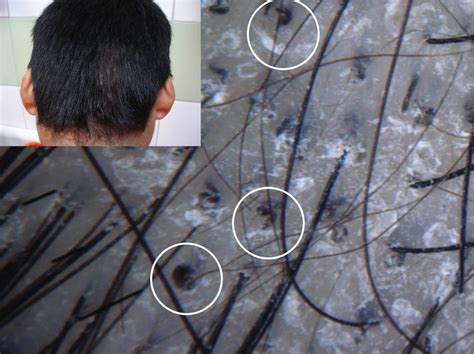 Dermatoscopia de cuero cabelludo mostrando pelos en sacacorchos en un caso de Tiña Capitis.