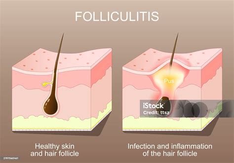 Ilustración de un folículo piloso inflamado o con foliculitis.