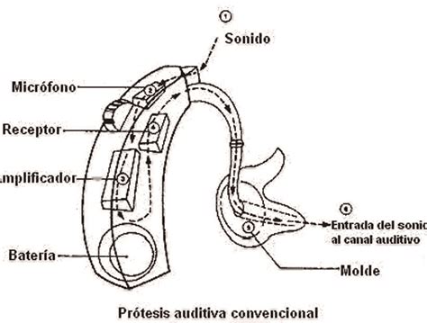 Esquema de las partes de un audífono y su colocación en el oído
