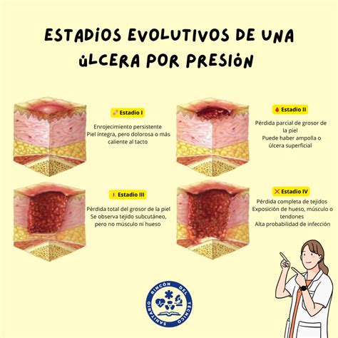 Diagrama de los diferentes estadios de una úlcera por presión