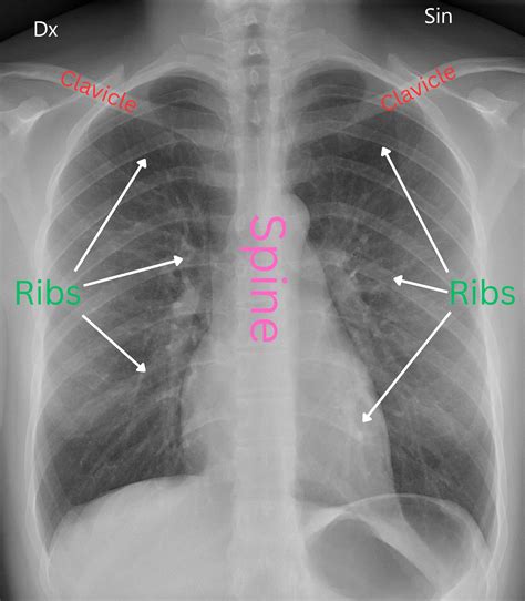 Radiografía de tórax mostrando signos de silicosis.