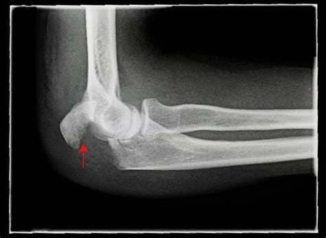 Radiografía lateral de una fractura de olécranon desplazada