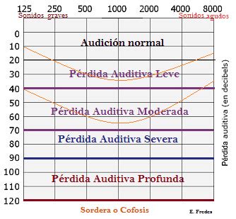 Gráfico comparativo de la prevalencia de diferentes tipos de pérdida auditiva en la población mayor.