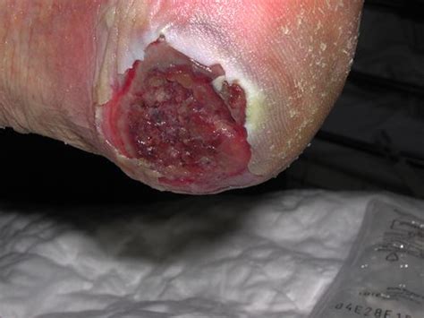 Foto de una úlcera por presión en talón, Categoría II, con signos de infección