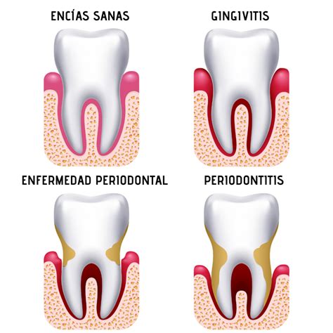 Esquema de las estructuras periodontales sanas y afectadas por periodontitis