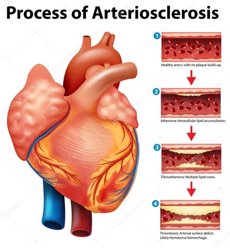 Esquema anatómico mostrando el proceso de arteriosclerosis y la obstrucción de una arteria coronaria