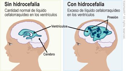 Infografía comparativa: diferencias en los síntomas de hidrocefalia entre bebés, niños y adultos.