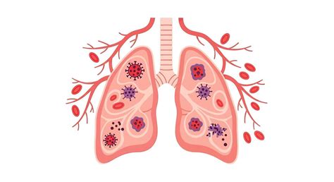 Esquema ilustrativo del sistema respiratorio afectado por el virus de la influenza