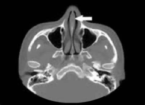 Radiografía o tomografía de la cavidad nasal de un perro mostrando un tumor o pólipo.