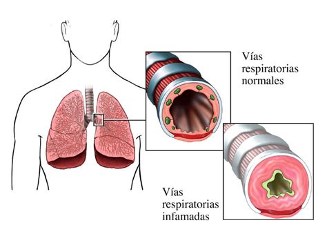 Esquema ilustrativo que muestra la inflamación y el estrechamiento de las vías respiratorias en un paciente asmático comparado con un pulmón sano.