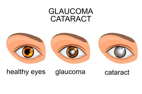 Infografía: Comparación visual de cataratas, glaucoma y DMAE