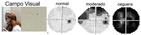 Diagrama: Campo visual afectado por glaucoma